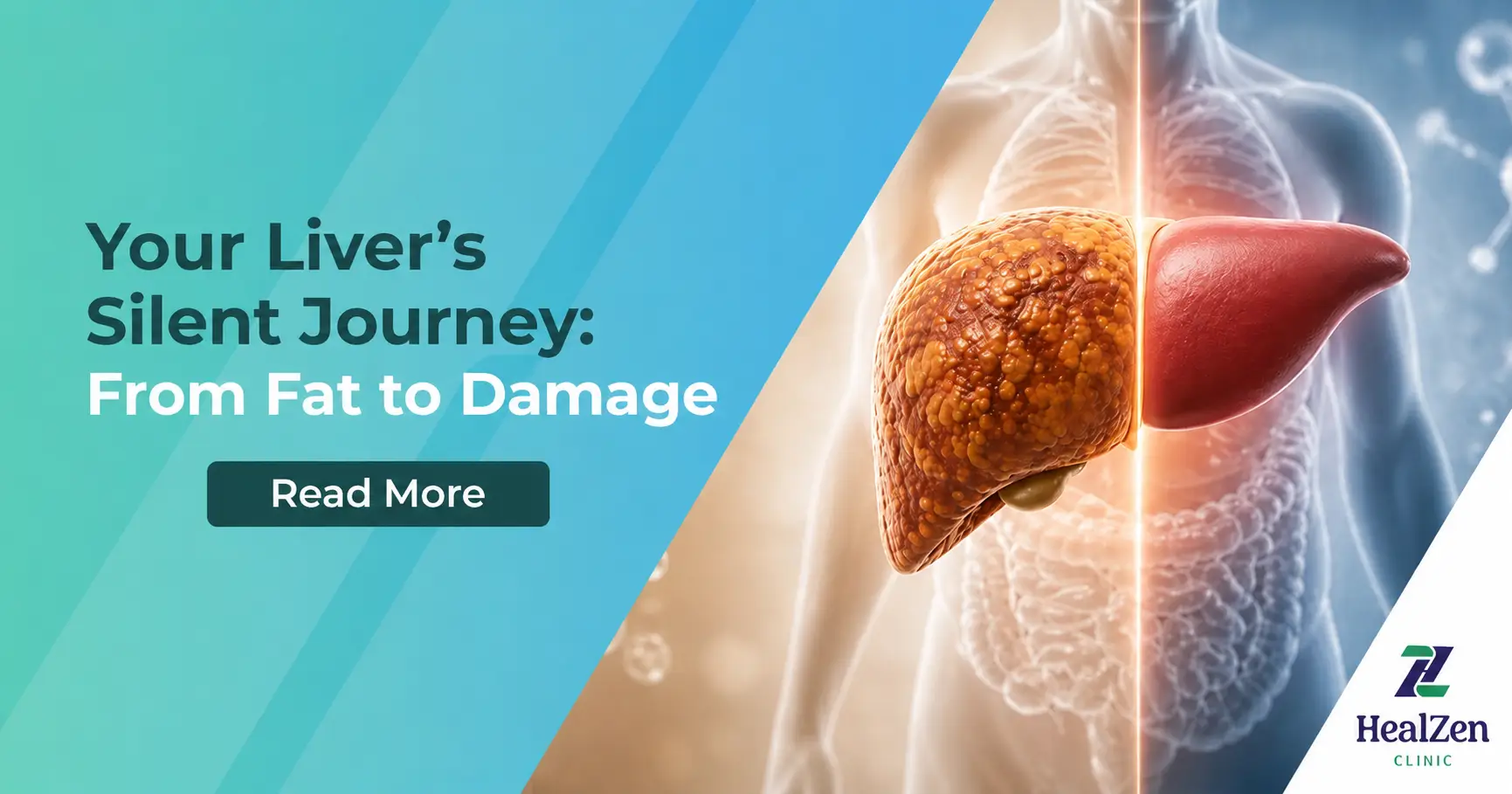 Your Liver’s Silent Journey From Fat to Damage Your Liver’s Silent Journey From Fat to Damage